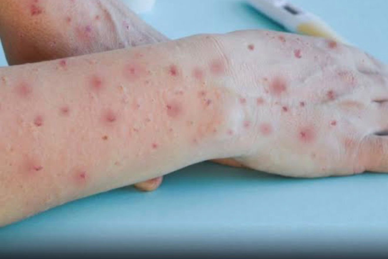 Another locally transmitted Mpox case detected in Karachi as clade 1b ...